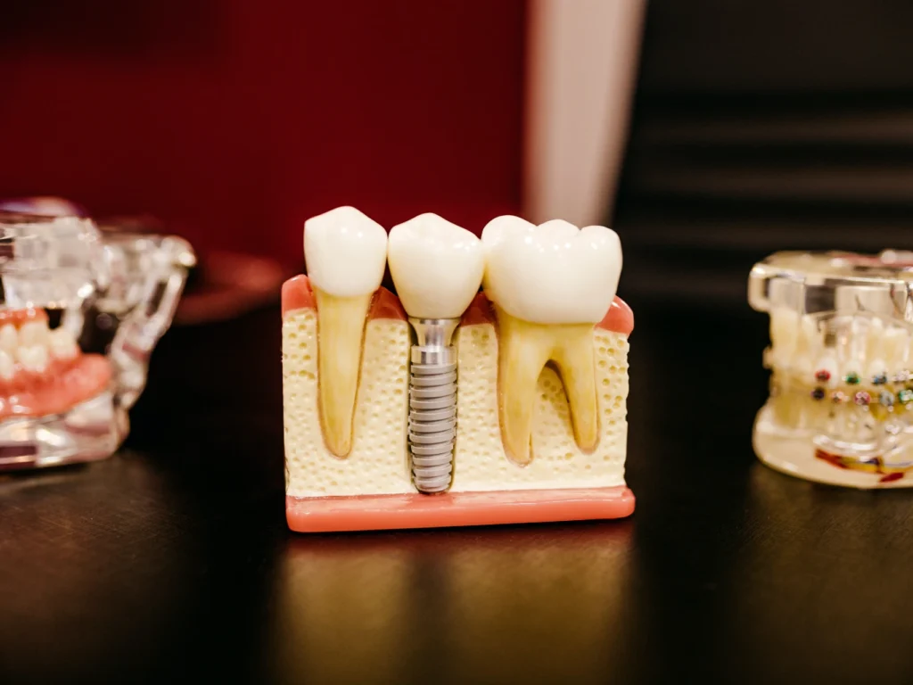 model of a single tooth dental implant | cost of dental implants in Northwest Florida